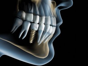 dental implants