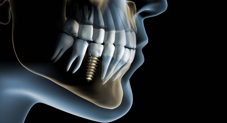 dental implants